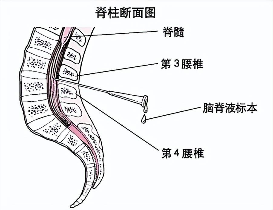 孩子不慎得了乙脑需要抽脊髓检查会影响智力吗