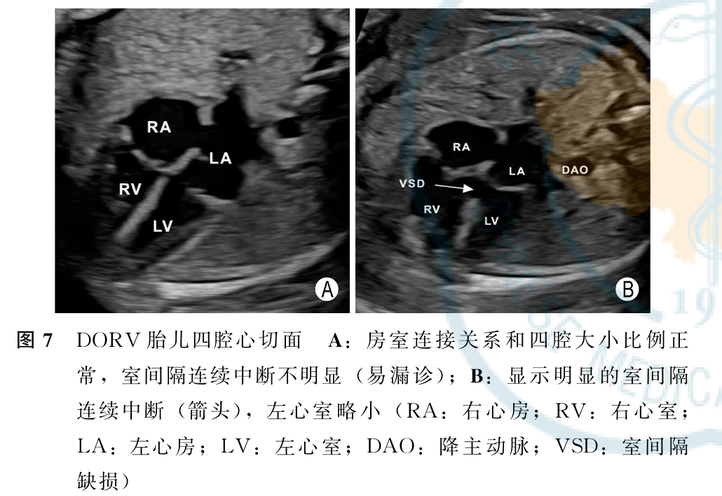 胎儿法洛四联症和右室双出口超声检查中国专家共识2022版二