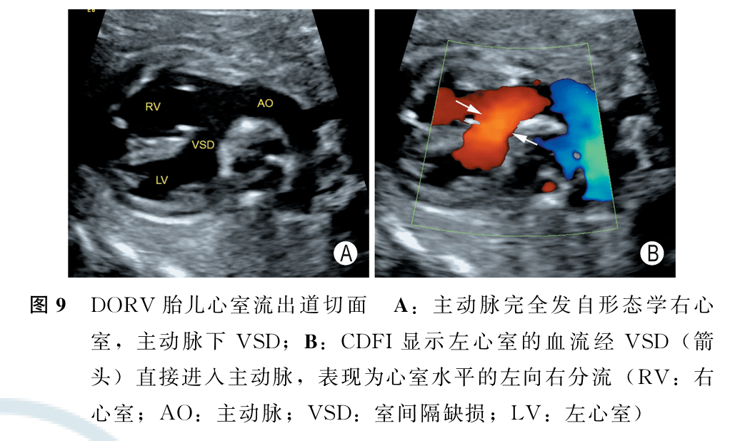 胎儿法洛四联症和右室双出口超声检查中国专家共识2022版二