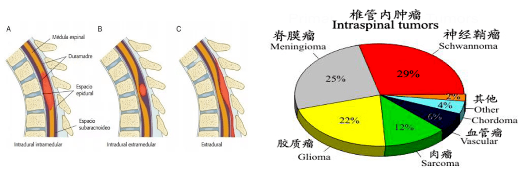 脊髓膜从内到外可分为软脊膜,蛛网膜和硬脊膜三层,更确切地说,脊膜瘤