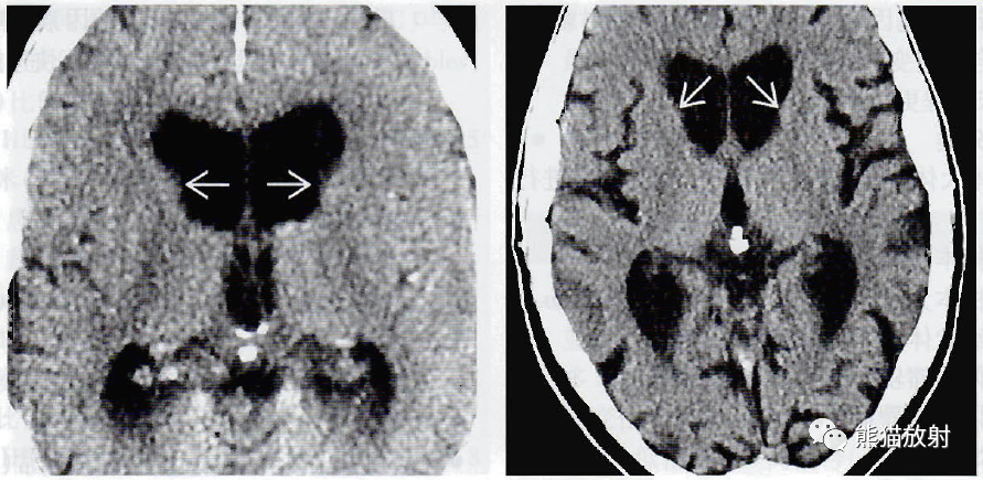 (左)尸检标本冠状位切面显示侧脑室(空箭)和环池(弯箭)扩大.
