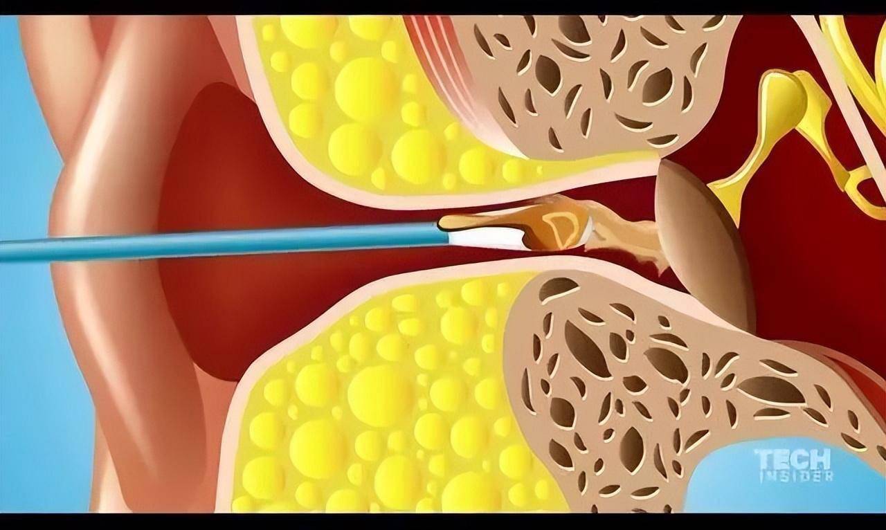 用棉签掏耳朵险丧命还有人得了癫痫甚至患癌
