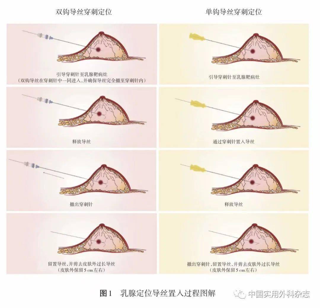 指南与共识|中国可视化经皮穿刺乳腺组织定位导丝与定位标记夹临床