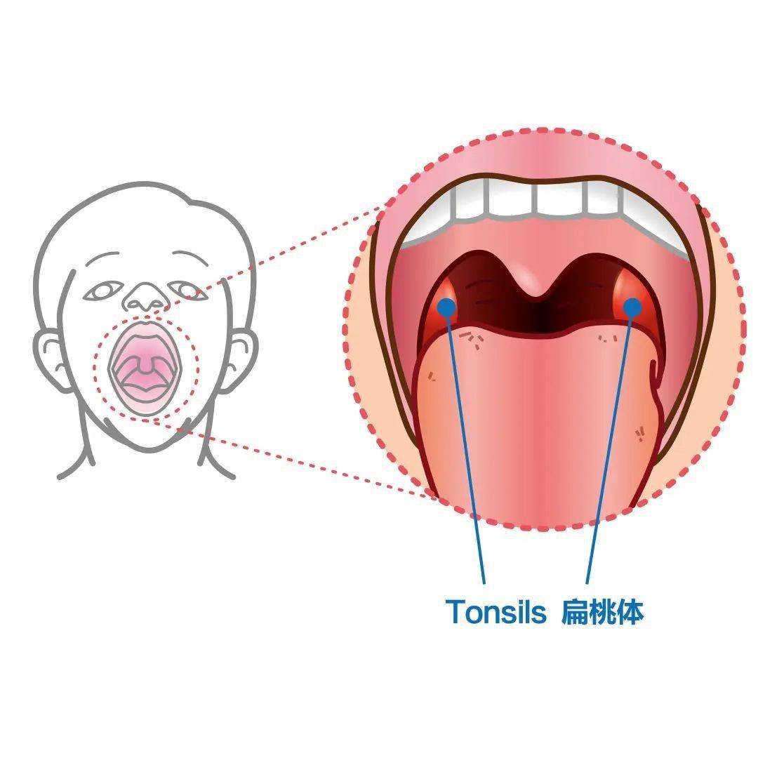 我们常吐槽的"发炎君—扁桃体,指的是位于舌顎弓和咽顎弓腭之间的