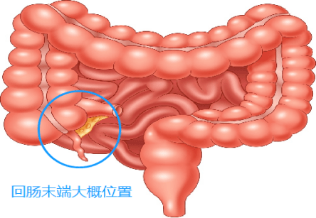 专家教你怎么办!_肠道_克罗恩_情况