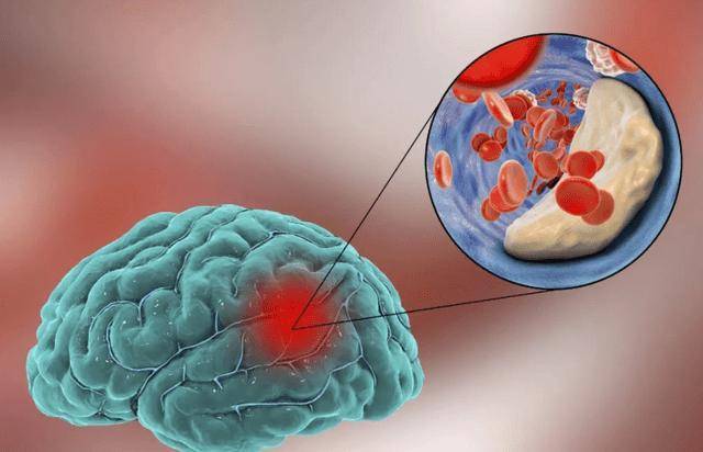 脑梗是“拖”出来的吗？睡觉时若有这3个现象，或要引起重视