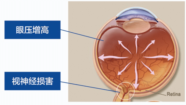 代生孩子（青光眼的不同类型及症状，你知道多少？）