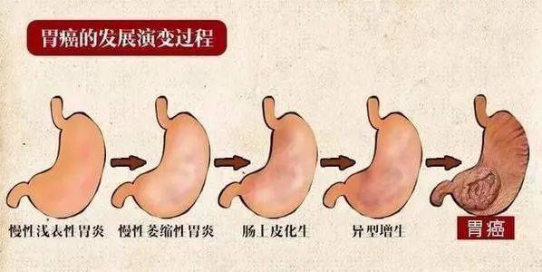 成都借卵费用（【汤医科普】慢性萎缩性胃炎是什么？肠化是癌前病变吗？）