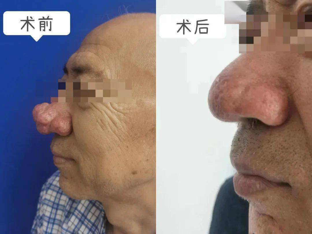 从此告别红鼻头_治疗_酒渣鼻_患者