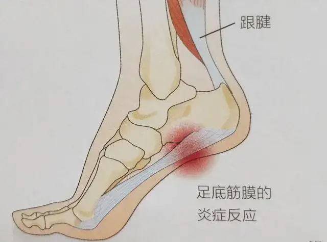 1,足底跖腱膜炎引起跟骨痛的原因?