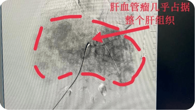 3个月大宝宝身体多脏器功能衰竭,检查后发现血管瘤占据了整个肝组织