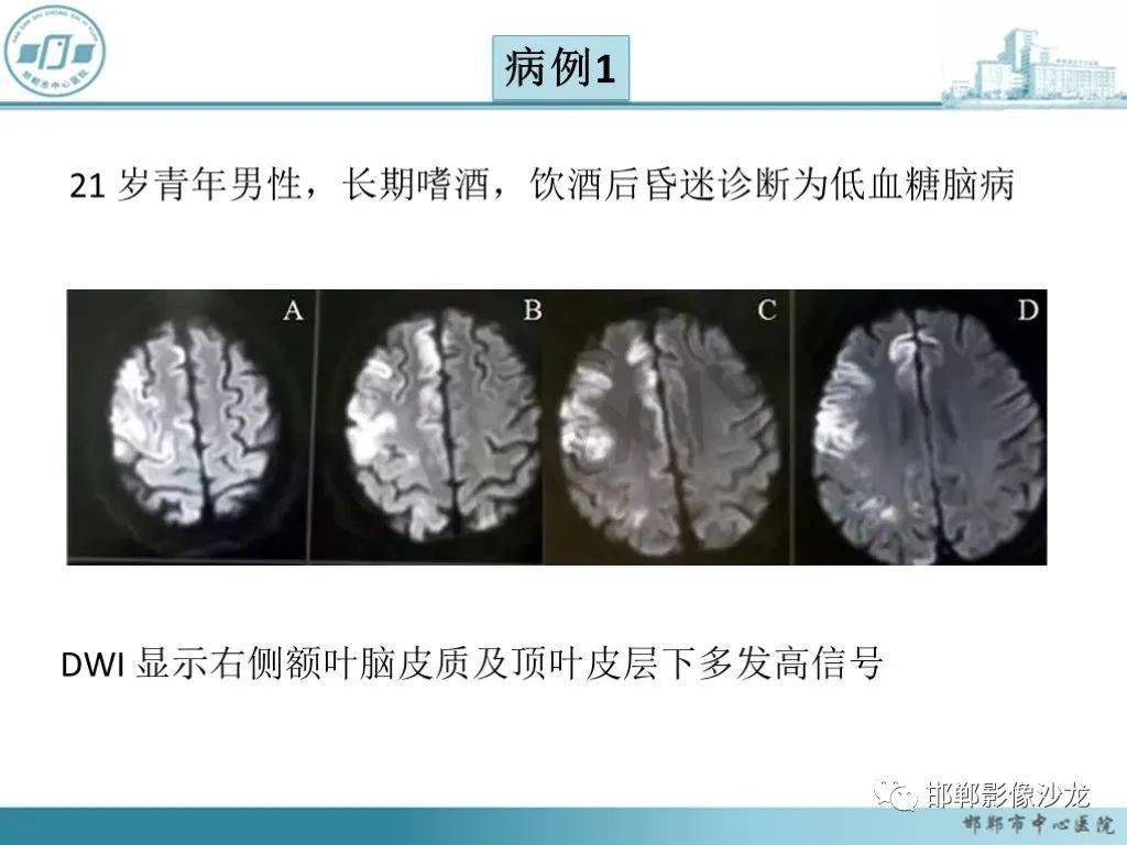 酒精性低血糖脑病
