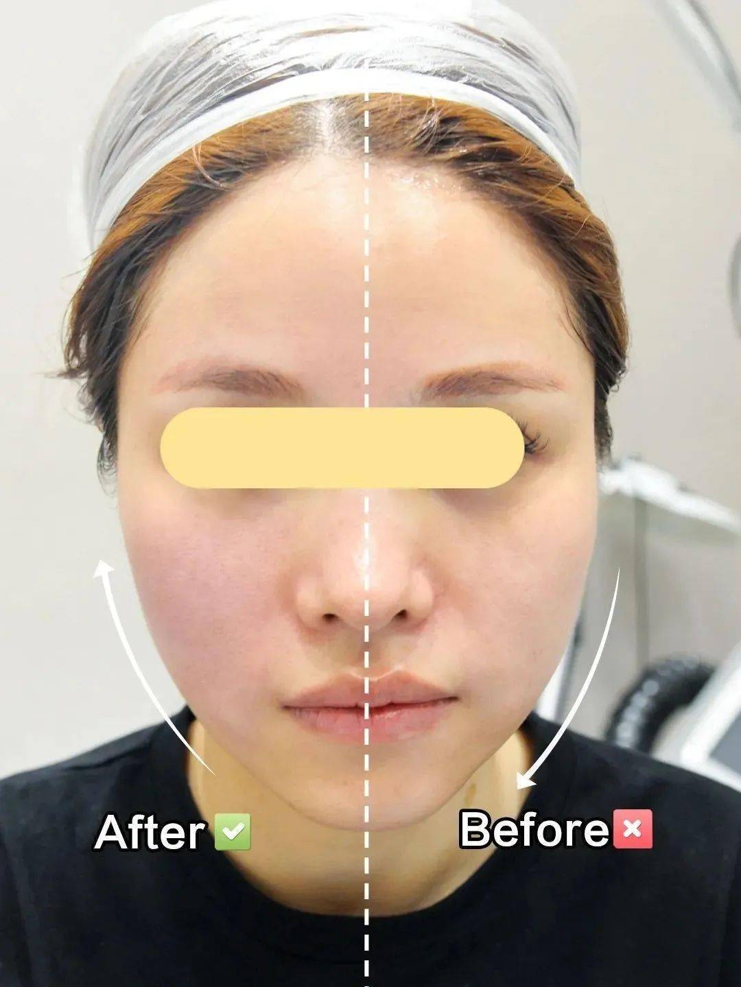 明星网红都在用的「胶原炮」！是不是智商税？