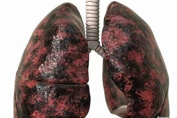 10年烟民的肺图片图片