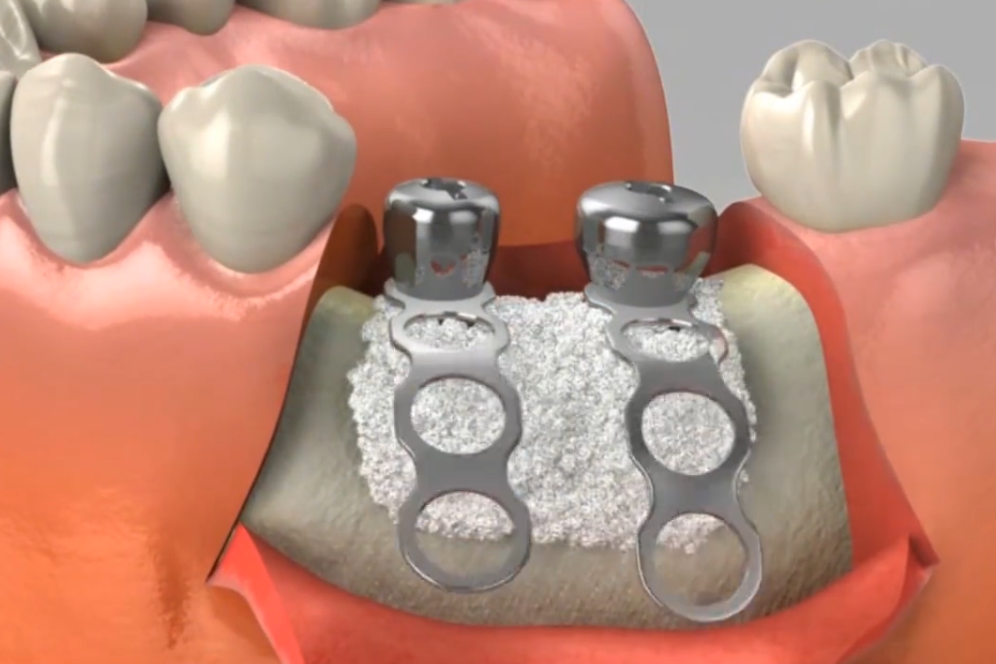 爱牙网种植牙牙骨萎缩时加骨粉的4种方法
