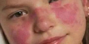 警惕！孩子身体发出的这些信号，可能是儿童红斑狼疮！