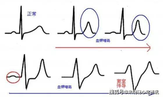 心電圖檢查:明明白白你的心_心臟