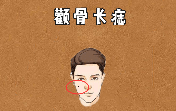 颧骨长痣