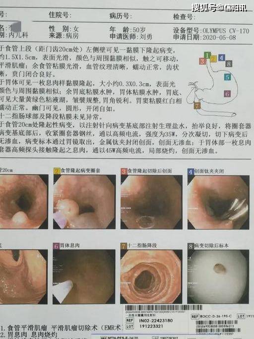 商城縣中醫院率先在我縣開展首例食管黏膜下良性腫瘤經消化內鏡微創