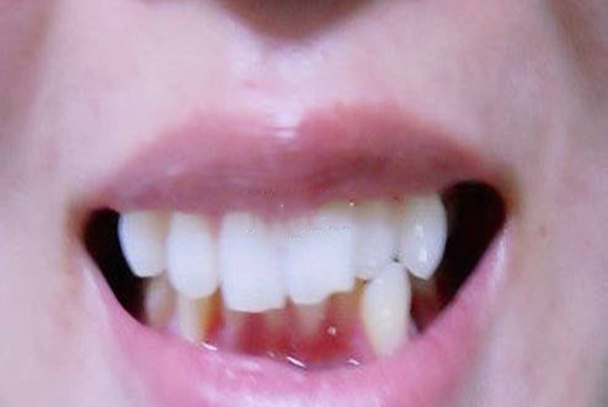 牙长歪了怎么办可以矫正吗（宝宝牙齿为什么会长歪？宝宝牙齿不齐，应该如何矫正？） | 说明书网
