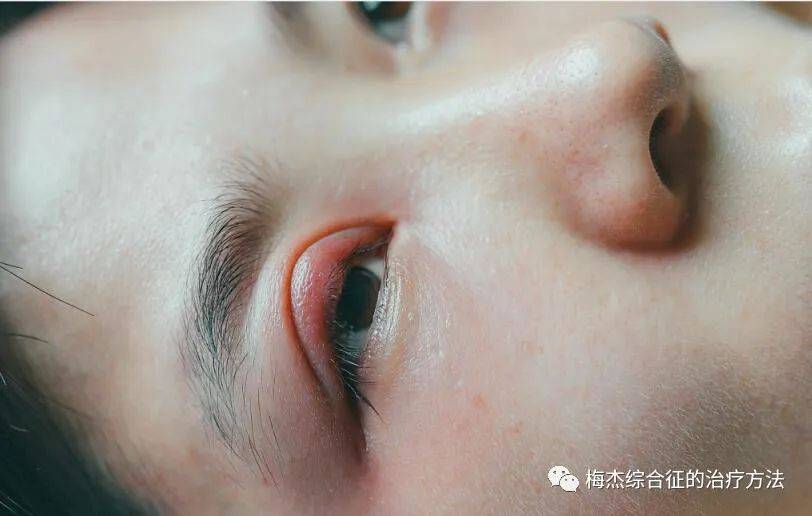 眼睑痉挛中医疗法,你不知道的那些知识