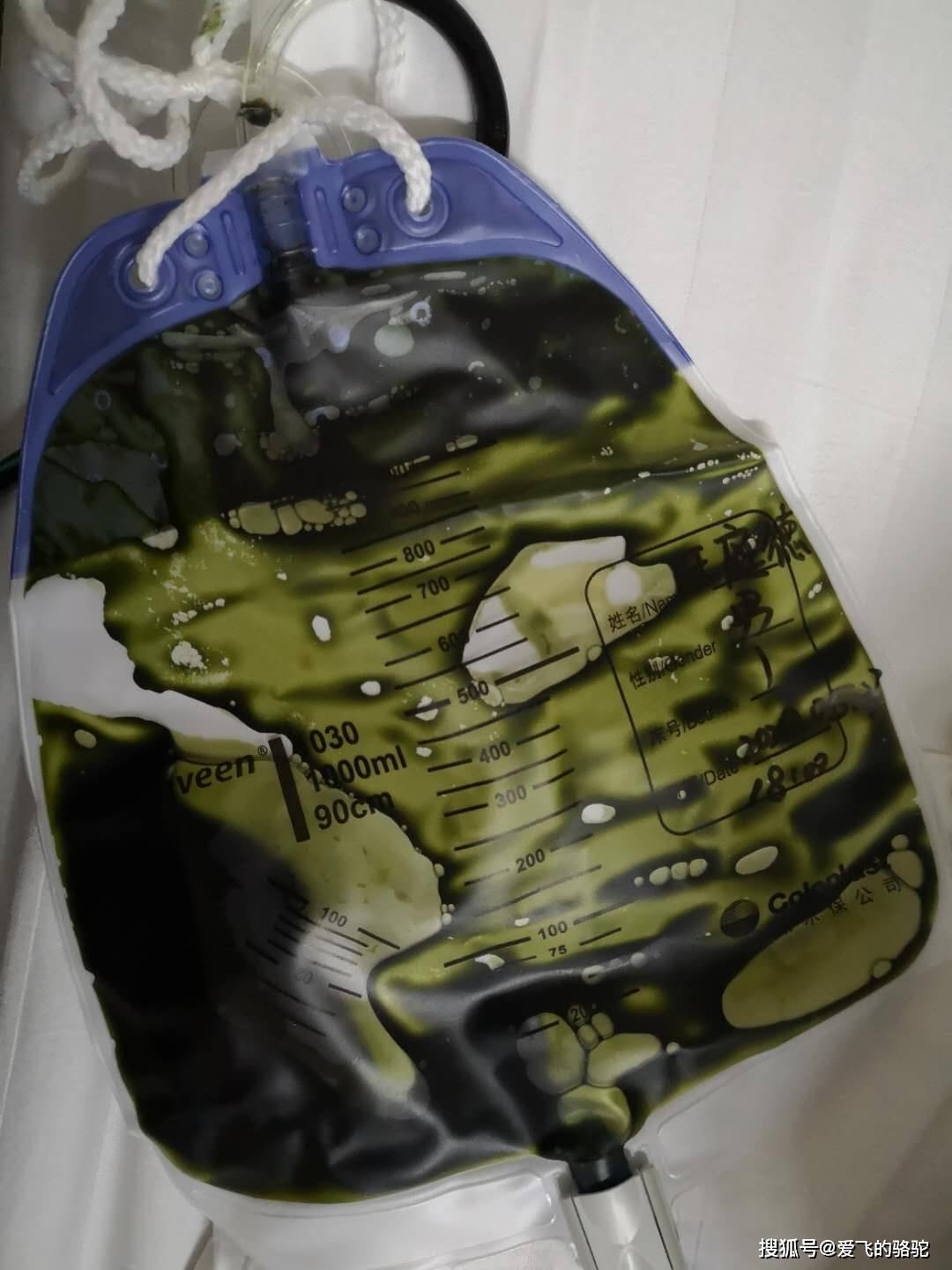 引流出来的暗黑色感染胆汁