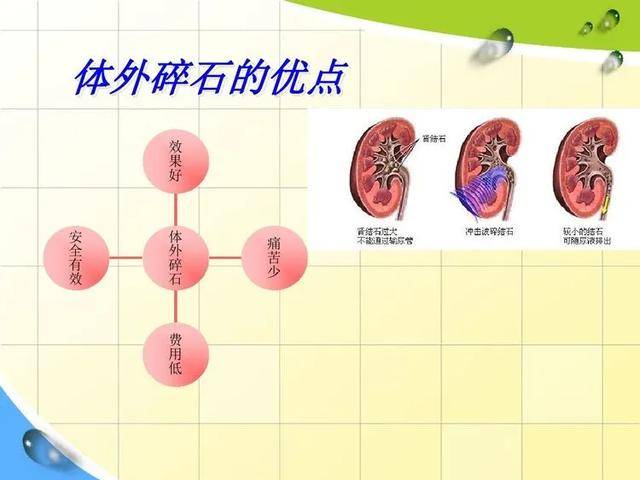 吕梁市中医院引进国内最高端"体外冲击波碎石机"