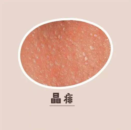 给宝宝的夏日礼包宝宝夏日护肤之防痱指南