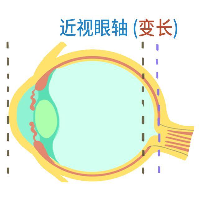 孩子戴ok镜不验光,为什么一直测眼轴?