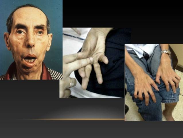 备孕须知:一些你不一定知道的常染色体显性遗传病(上)