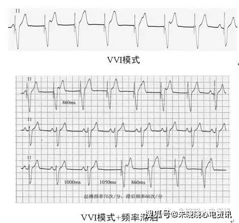 双腔起搏器心电图图片