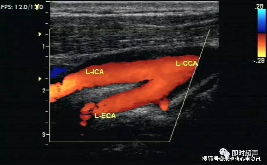 血管超声检查技术