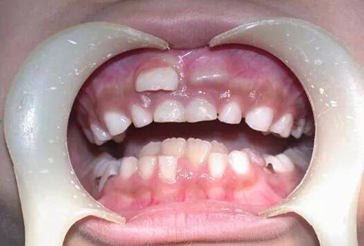 乳牙滞留的危害乳牙滞留占据了恒牙萌出的正常位置,恒牙可能会异位萌