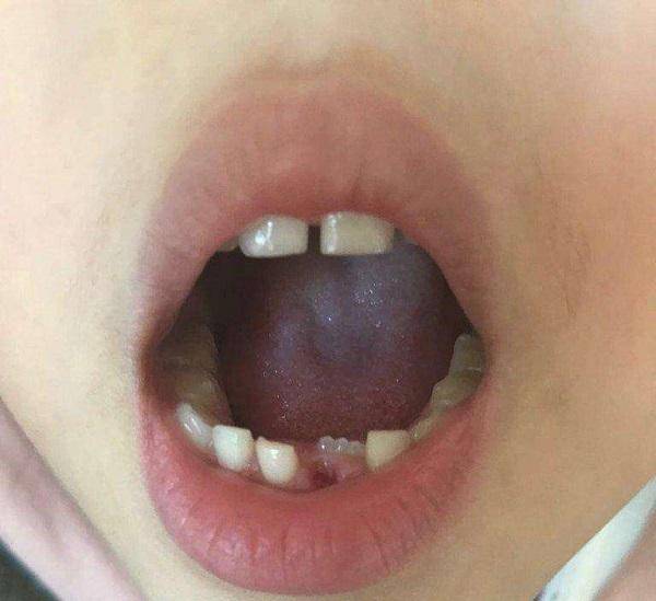 儿童换牙牙龈裂开图片图片