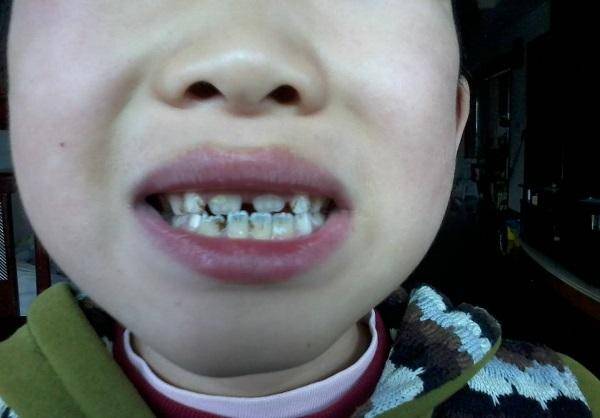 原创"下牙往高扔,上牙往低扔?"儿童换牙期护理,需注意这5个方面