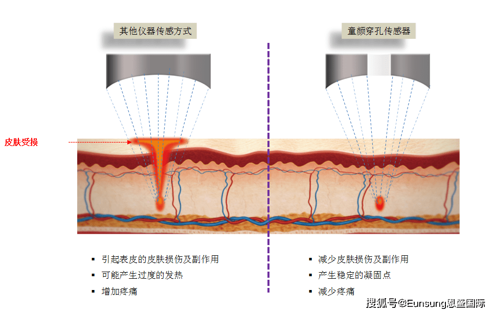 什么是滑动超声刀技术?