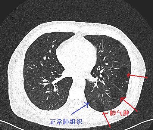 经典图谱实战图谱一文看懂肺气肿