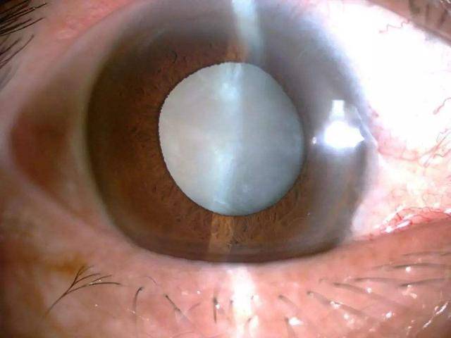 白内障只是看不清,不会致盲?600万白内障患者:这5个误区别再犯