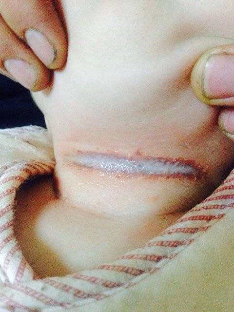 夏季宝宝"淹脖子"怎么办?2招解决!真不怪宝宝胖,只因妈妈懒