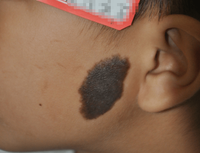 河北省中医院:宝宝黑胎记怎么治疗?_患者