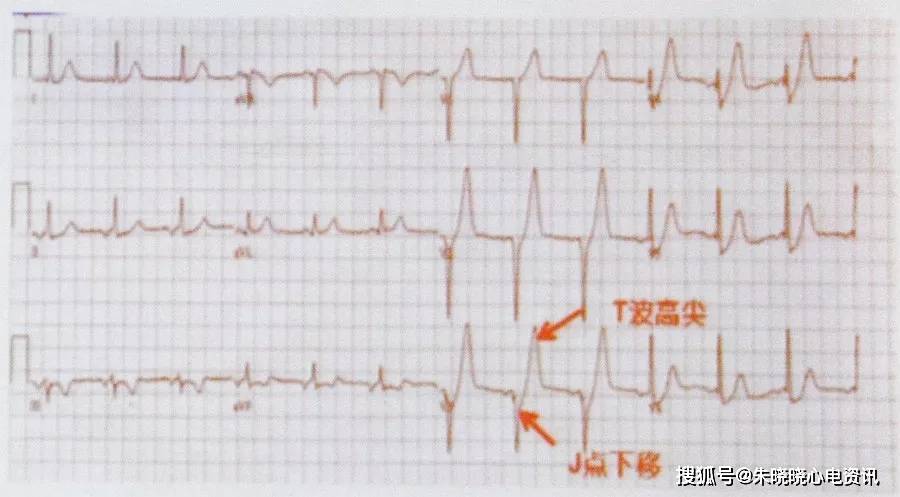 ①胸前v1~v6導聯j點壓低1~3 mm,st段呈上斜型下移,隨後t波對稱高尖