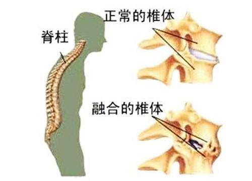 强直性脊柱炎并发症有哪些?骨科医生张建福教你症状自查