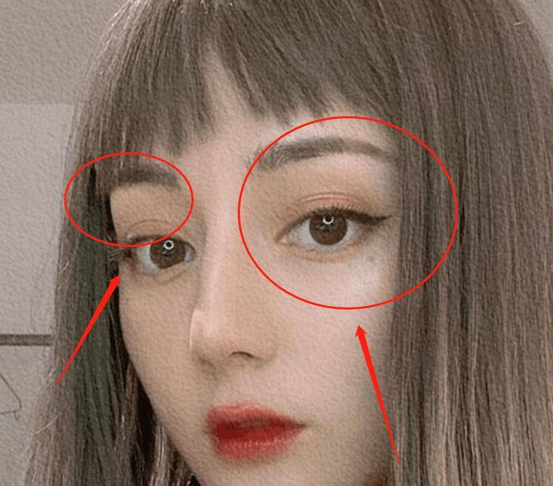 迪丽热巴双眼皮疤痕图片