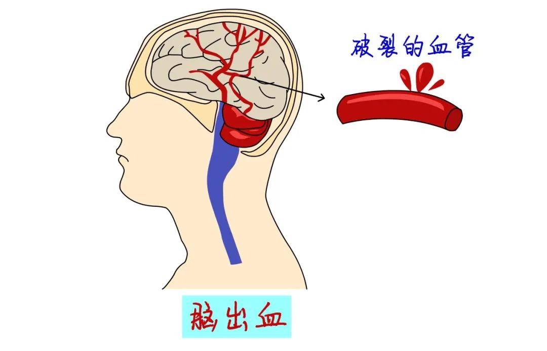 突发脑溢血该如何急救掌握这四点关键时刻可以增加突发患者的生存几率