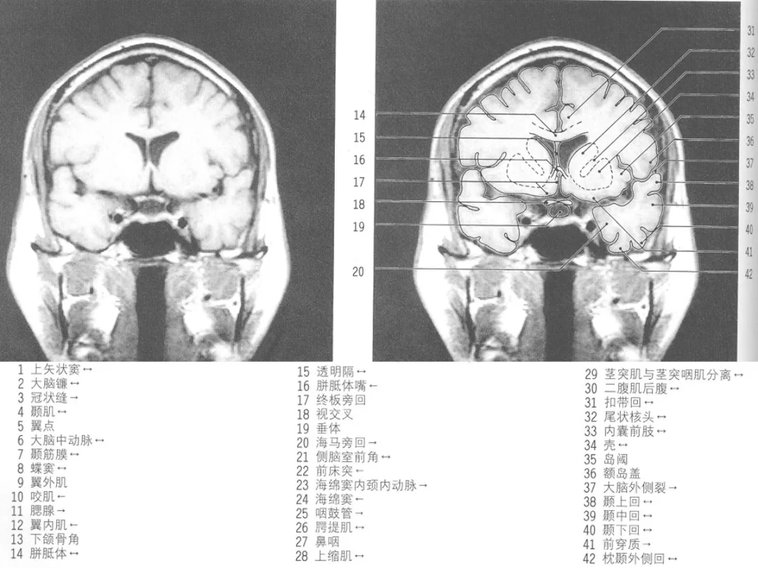 影像基礎mri顱腦冠狀位解剖圖譜