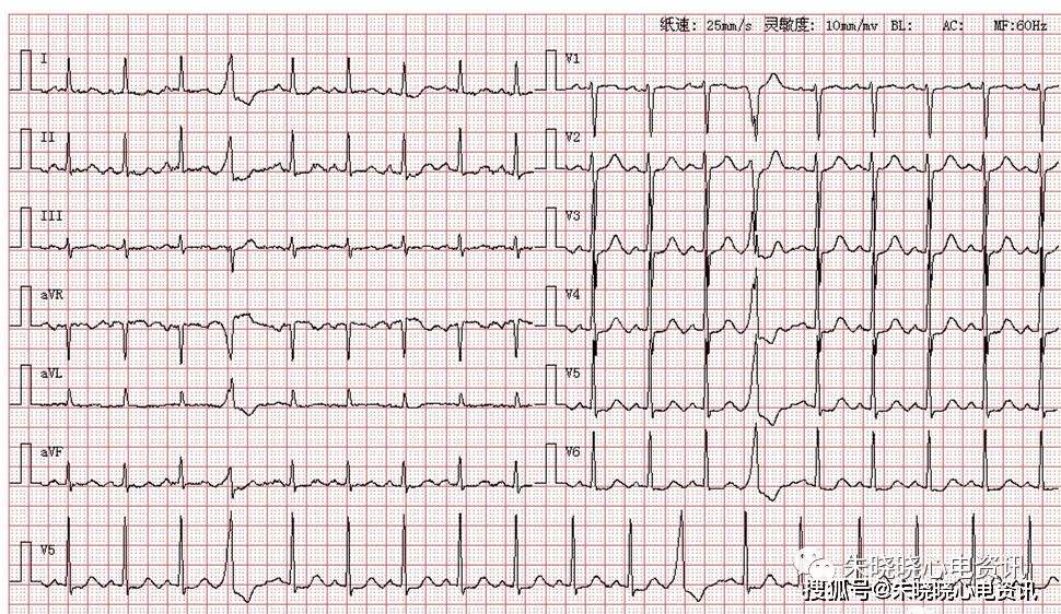 第1069期讀圖 患者男,54歲,因胸悶心悸來醫院就診,圖為其體檢心電圖