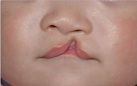 这个宝宝呢是一个先天性的左侧的不完全性的唇裂,他是个腭露的唇裂