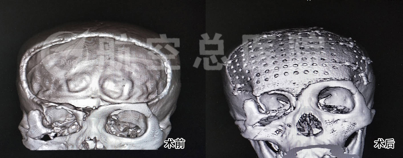 【专家观点】颅骨缺损危害大,peek颅骨修复整形效果好 穆苍山主任介绍