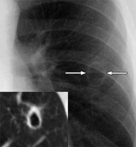 「肺部感染」可能出現的「ct徵象」(下),全面總結!