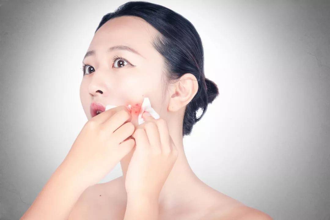 【趣痘驿站百问百科】痤疮一出,颜面扫地,怎样拯救痘痘肌?